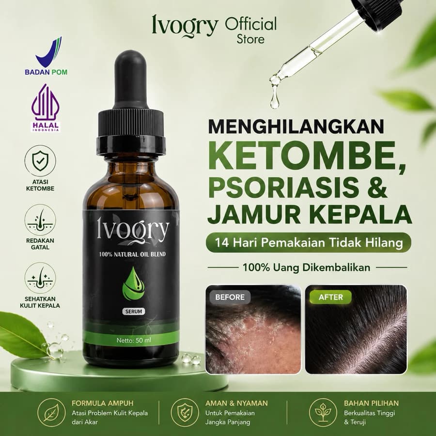 Ivogry Dandruff Treatment